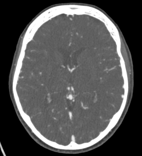 File:Basilar tip aneurysm with coiling (Radiopaedia 53912-60086 A 80).jpg