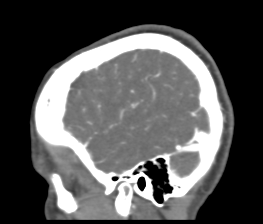 File:Basilar tip aneurysm with coiling (Radiopaedia 53912-60086 C 116).jpg