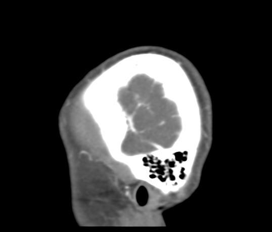 Basilar tip aneurysm with coiling (Radiopaedia 53912-60086 C 130).jpg