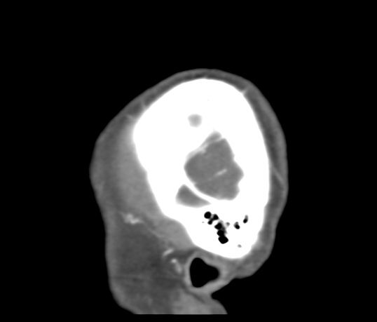 Basilar tip aneurysm with coiling (Radiopaedia 53912-60086 C 132).jpg