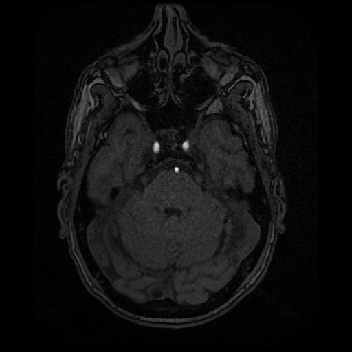 Basilar top and left middle cerebral artery aneurysm (Radiopaedia 61965-70031 Axial MRA 42).jpg