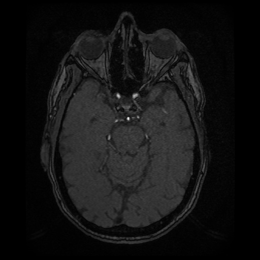 Basilar top and left middle cerebral artery aneurysm (Radiopaedia 61965-70031 Axial MRA 57).jpg