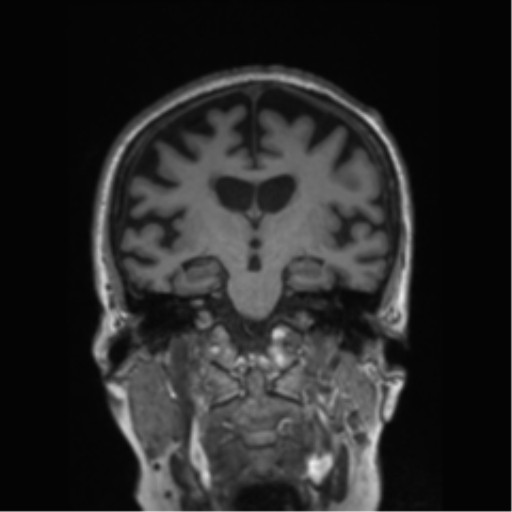 Behavioral variant frontotemporal dementia and late onset schizophrenia (Radiopaedia 52197-58083 Coronal T1 49).png