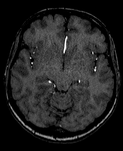 File:Berry aneurysm of the terminal internal carotid artery (Radiopaedia 88286-104918 Axial TOF 114).jpg