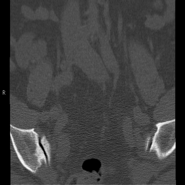 Bertolotti syndrome (Radiopaedia 24864-25128 Coronal bone window 5).jpg