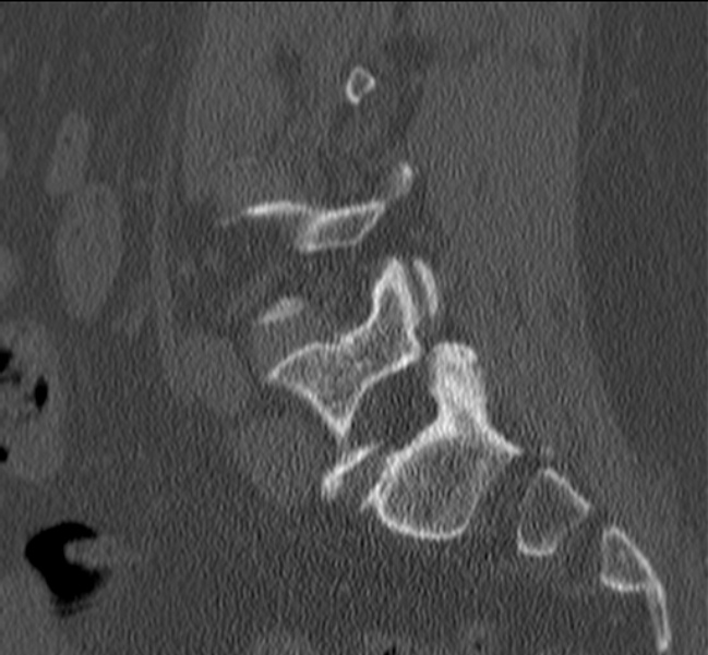 Bertolotti syndrome (Radiopaedia 24864-25128 Sagittal bone window 39).jpg