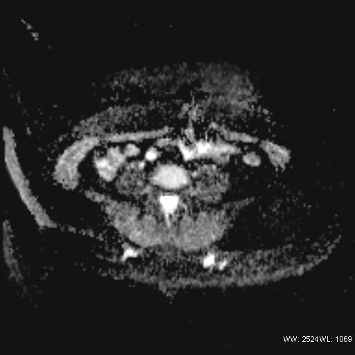 File:Bicornuate uterus- on MRI (Radiopaedia 49206-54297 Axial ADC 2).jpg