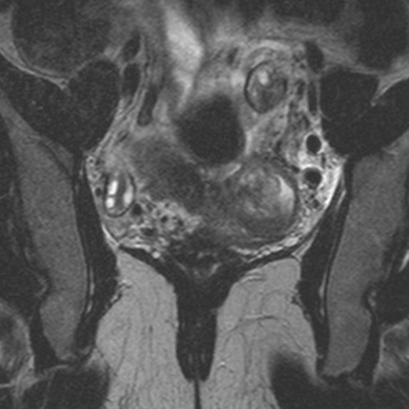 File:Bicornuate uterus (Radiopaedia 24677-24949 Coronal T2 10).jpg