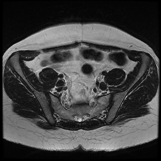 File:Bicornuate uterus (Radiopaedia 51676-57472 Axial T2 26).jpg
