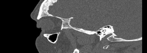 Bilateral Ectopic Infraorbital Nerves (Radiopaedia 49006-54084 Sagittal bone window 4).jpg