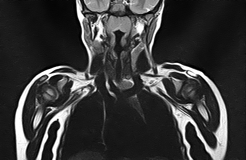 File:Bilateral Sprengel deformity with Klippel-Feil syndrome (Radiopaedia 66395-75650 Coronal T2 9).jpg
