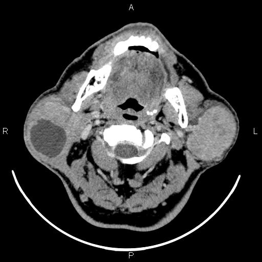 Bilateral Warthin tumors (Radiopaedia 84034-99263 Axial With contrast 24).jpg