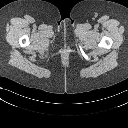 Bilateral acetabular protrusion with pincer type femoro-acetabular impingement (Radiopaedia 30134-30733 AXIAL SOFT THIN 117).jpg