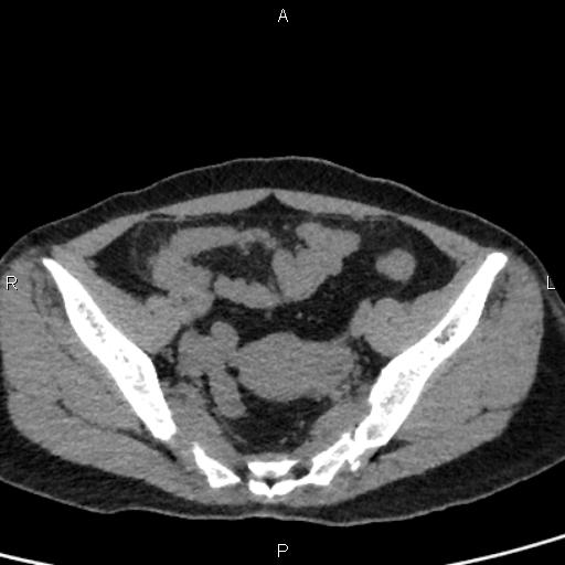 Bilateral adrenal gland hyperenhancement in pancreatitis (Radiopaedia 86642-102753 Axial non-contrast 92).jpg