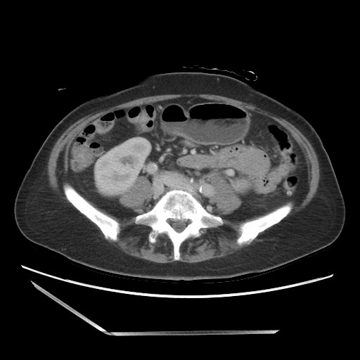 Bilateral adrenal granulocytic sarcomas (chloromas) (Radiopaedia 78375-91007 A 72).jpg