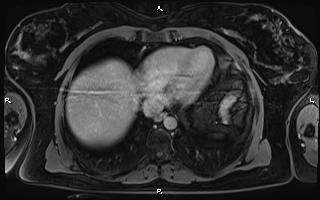File:Bilateral adrenal myelolipoma (Radiopaedia 63058-71537 H 11).jpg
