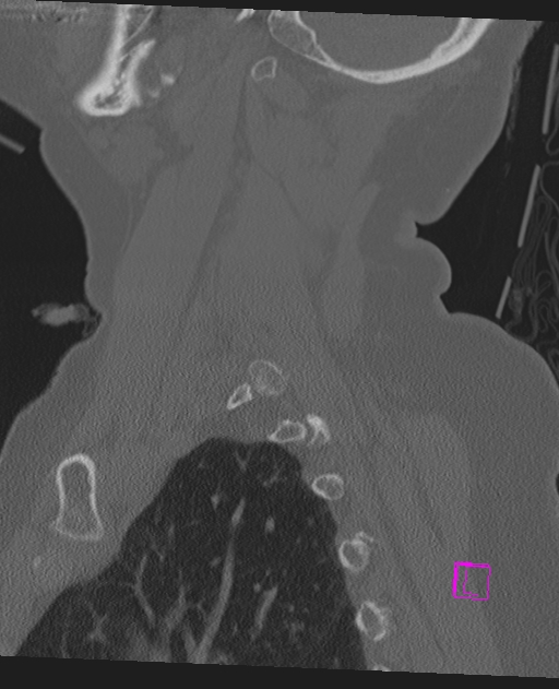 Bilateral atlanto-occipital assimilation (Radiopaedia 28350-28603 Sagittal bone window 63).jpg