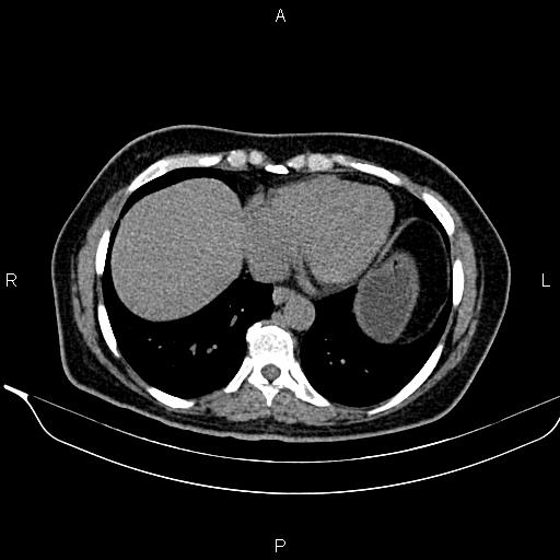 File:Bilateral benign adrenal adenomas (Radiopaedia 86912-103124 Axial non-contrast 14).jpg