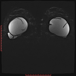 File:Bilateral breast implant rupture (Radiopaedia 24761-25027 PASTA Si IR 14).jpg