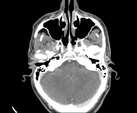 Bilateral carotid body tumors (Radiopaedia 61841-69870 Axial Post contrast 1).jpg
