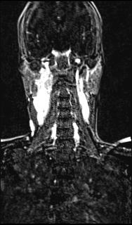 Bilateral carotid body tumors and right glomus jugulare tumor (Radiopaedia 20024-20060 MRA 107).jpg