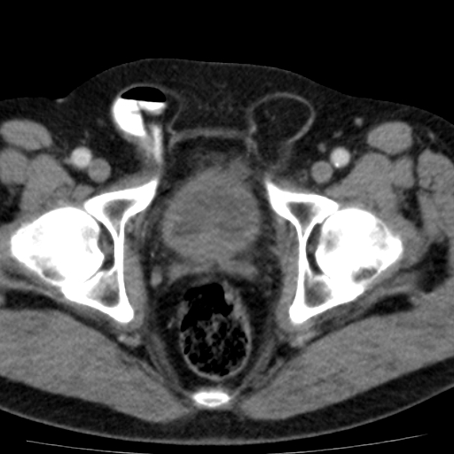 File:Bilateral direct inguinal herniae (Radiopaedia 17016-16719 B 19).jpg