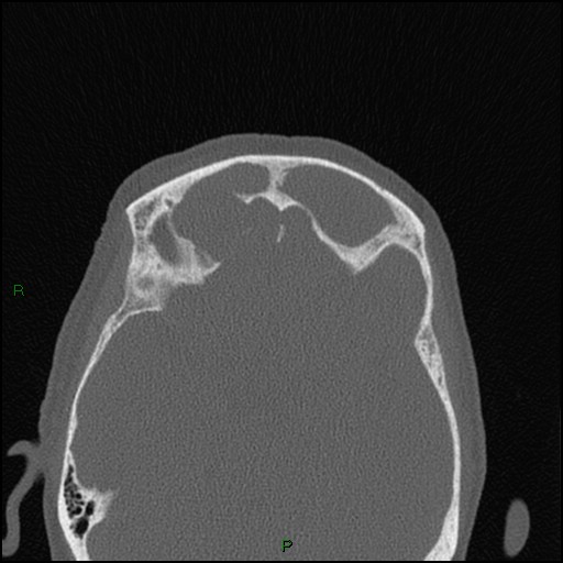 Bilateral frontal mucoceles (Radiopaedia 82352-96454 Axial bone window 106).jpg