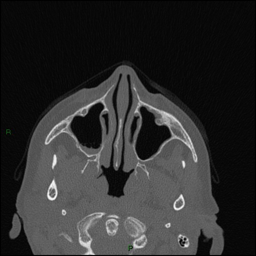 Bilateral frontal mucoceles (Radiopaedia 82352-96454 Axial bone window 197).jpg
