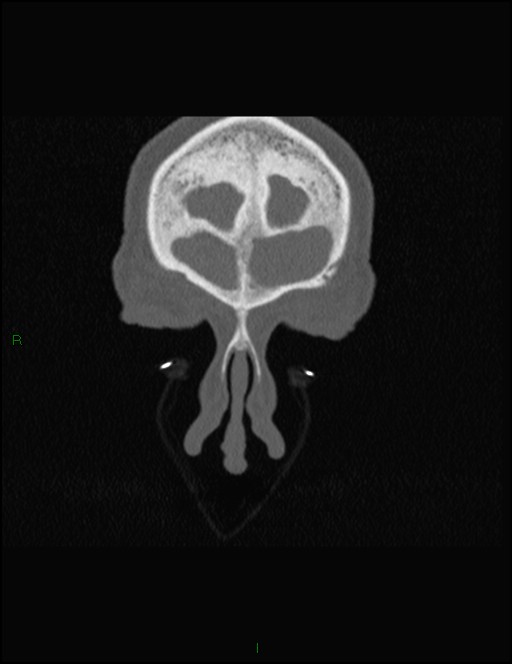 Bilateral frontal mucoceles (Radiopaedia 82352-96454 Coronal 45).jpg