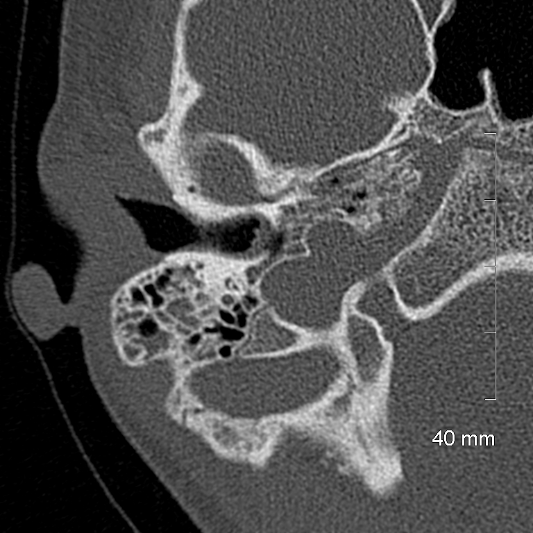 Bilateral grommets (Radiopaedia 47710-52404 Axial bone window 22).jpg
