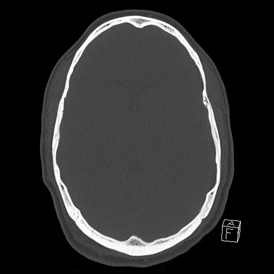 Bilateral occipital condyle fracture (type 2) (Radiopaedia 87675-104089 Axial bone window 65).jpg