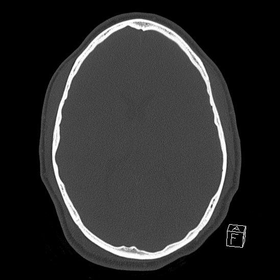 File:Bilateral occipital condyle fracture (type 2) (Radiopaedia 87675-104089 Axial bone window 78).jpg