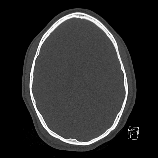 Bilateral occipital condyle fracture (type 2) (Radiopaedia 87675-104089 Axial bone window 84).jpg