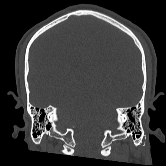 Bilateral occipital condyle fracture (type 2) (Radiopaedia 87675-104089 Coronal bone window 86).jpg