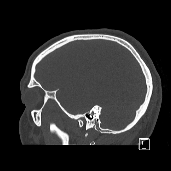 Bilateral occipital condyle fracture (type 2) (Radiopaedia 87675-104089 Sagittal bone window 17).jpg