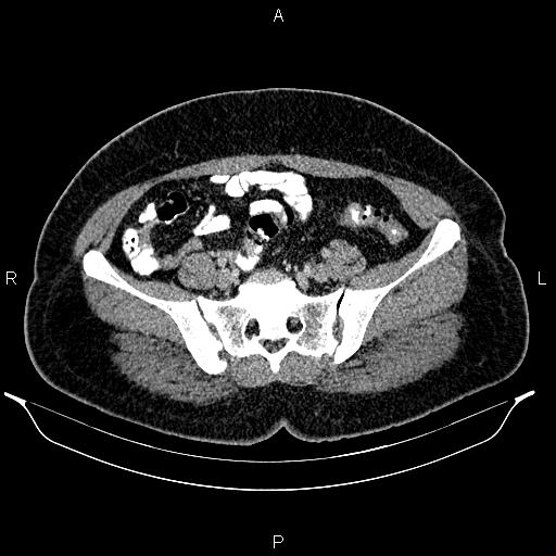 Bilateral ovarian dermoid cysts (Radiopaedia 85785-101603 A 80).jpg
