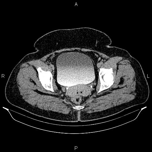 Bilateral ovarian dermoid cysts (Radiopaedia 85785-101603 Axial C+ delayed 78).jpg