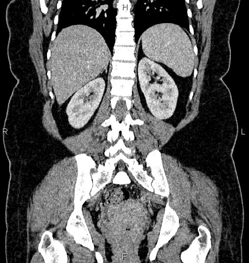 File:Bilateral ovarian dermoid cysts (Radiopaedia 85785-101603 C 42).jpg