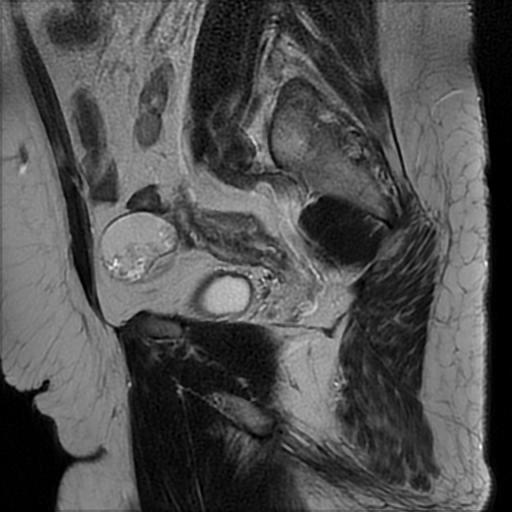 File:Bilateral ovarian dermoid cysts (Radiopaedia 90152-107338 Sagittal T2 19).jpg