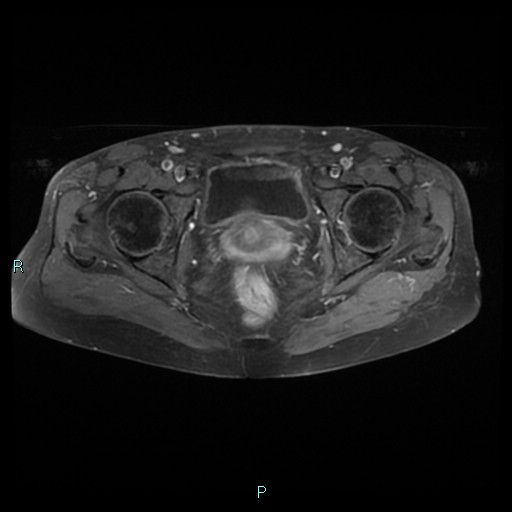 File:Bilateral ovarian fibroma (Radiopaedia 44568-48293 Axial T1 C+ fat sat 21).jpg