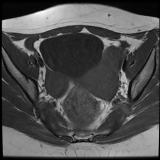 File:Bilateral ovarian fibrothecomas - adolescent (Radiopaedia 86604-102707 Axial T1 15).jpg