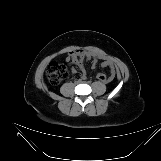 Bilateral ovarian mature cystic teratomas (Radiopaedia 79373-92457 Axial non-contrast 31).jpg