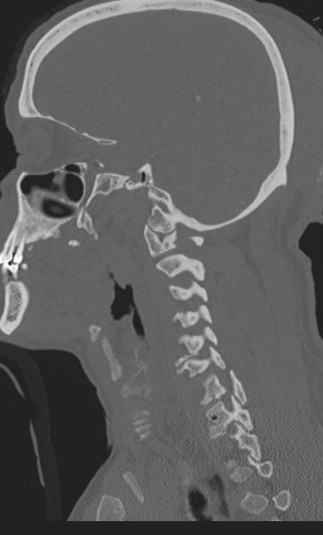 Bilateral perched facet joint (Radiopaedia 63149-71669 Sagittal bone window 48).jpg