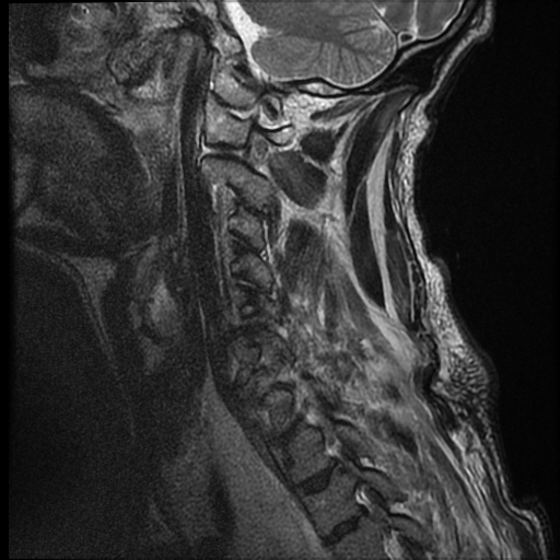 File:Bilateral perched facets with cord injury (Radiopaedia 45587-49714 Sagittal T2 3).jpg