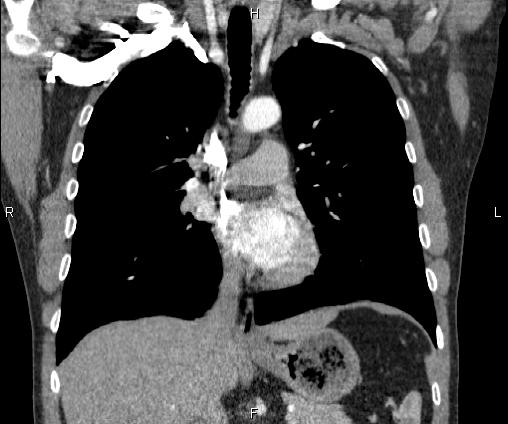 Bilateral pulmonary AVM (Radiopaedia 83134-97505 C 37).jpg
