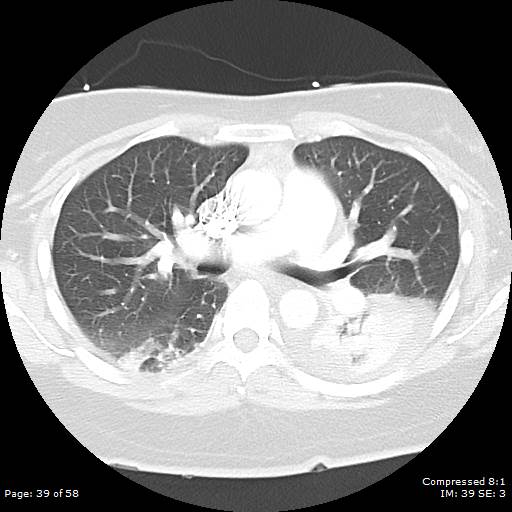 Bilateral pulmonary emboli with Hampton hump sign (Radiopaedia 54070-60246 Axial lung window 39).jpg