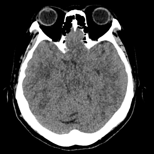 Bilateral subacute subdural hematoma (Radiopaedia 69240-79018 Axial non-contrast 18).jpg