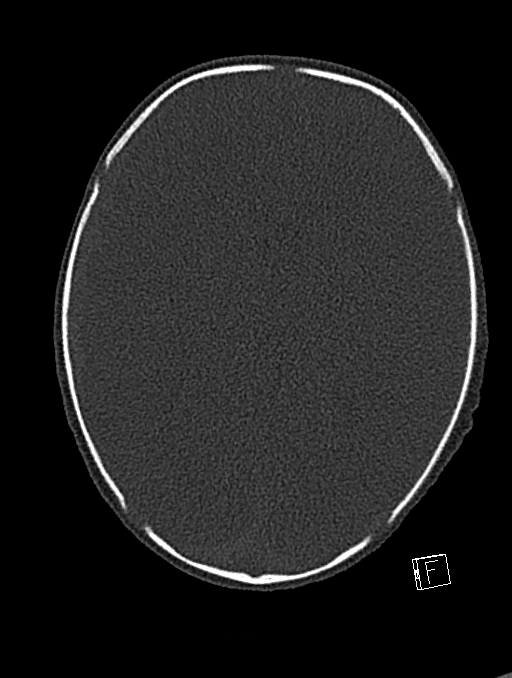 Bilateral subdural hemorrhage and parietal skull fracture (Radiopaedia 26058-26192 Axial bone window 60).png