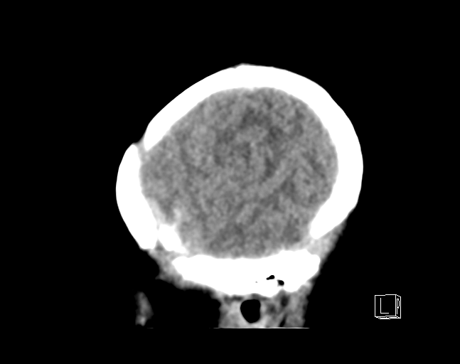 File:Bilateral subdural hemorrhage and parietal skull fracture (Radiopaedia 26058-26192 C 21).png