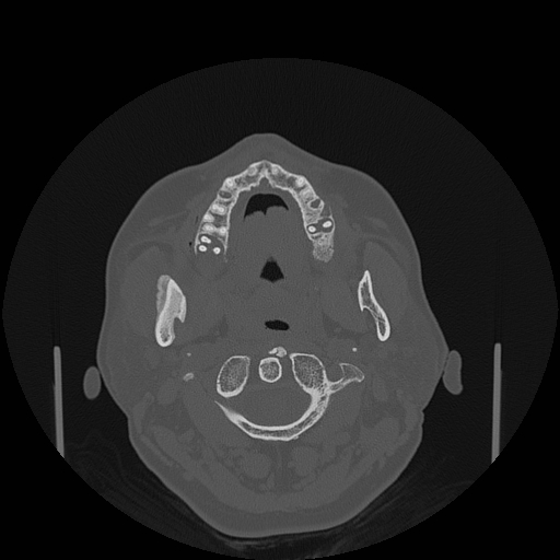 File:Bisphosphonate-related osteonecrosis of the jaw (Radiopaedia 71324-81642 Axial bone window 103).jpg